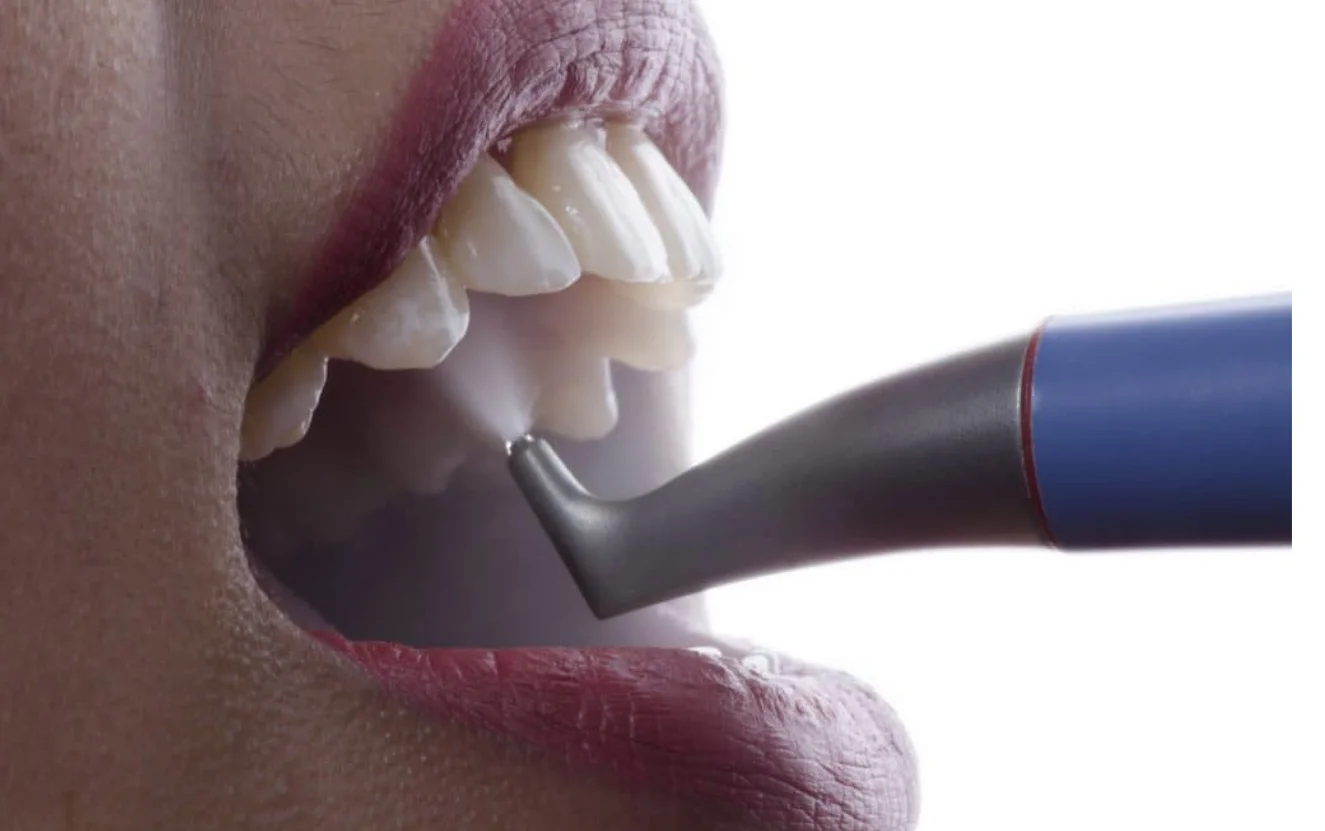 Dental Hygiene Air Polisher Treatments Kidbrooke Consultation Availability Announced at Kidbrooke Village Dentist (Smile 4 U)